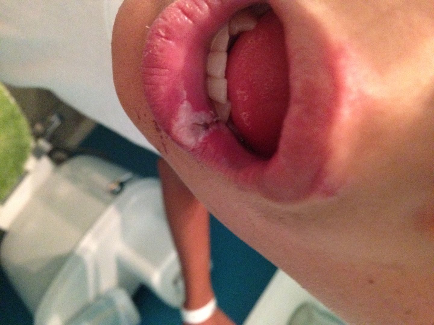 Stitches Inside Mouth